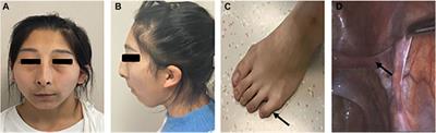 Case Report: Novel Compound Heterozygotic Variants in PPP2R3C Gene Causing Syndromic 46, XY Gonadal Dysgenesis and Literature Review